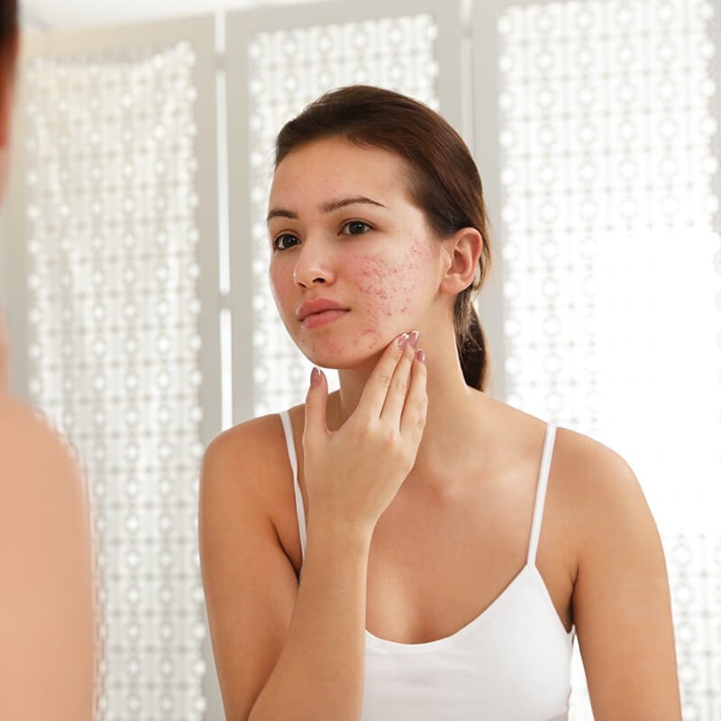 Acne Scarring in Danville, CA | Elite MD